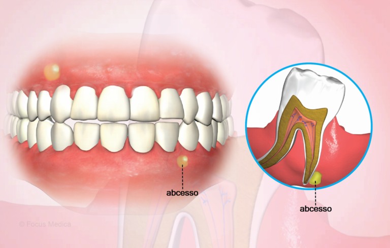 Abscesso Dentário: Entenda as Causas, Sintomas e Como Tratar Antes que ...